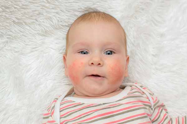 Лекарственная аллергия у детей: симптомы и лечение Часть 2